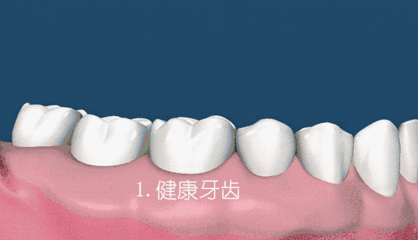 这样恶化循环,最后的结果是牙齿松动,脱落.
